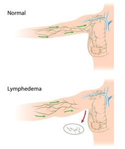 Lymphoedème secondaire
