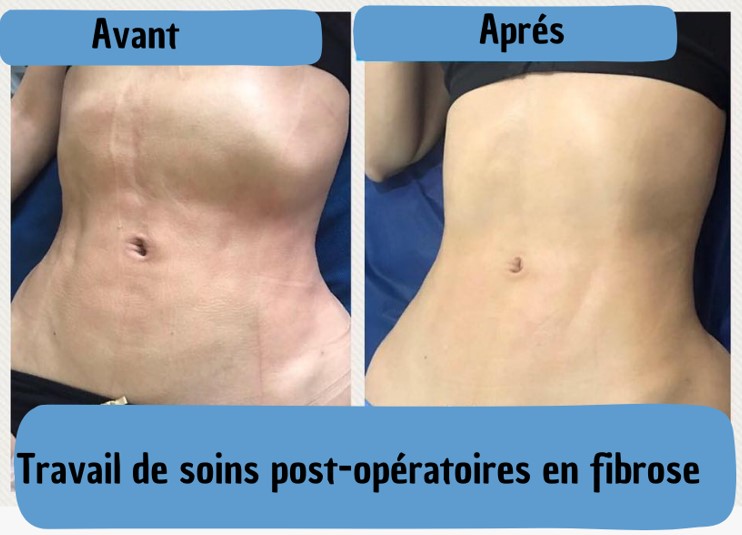 Œdème post-opératoire (inflammation après une chirurgie)